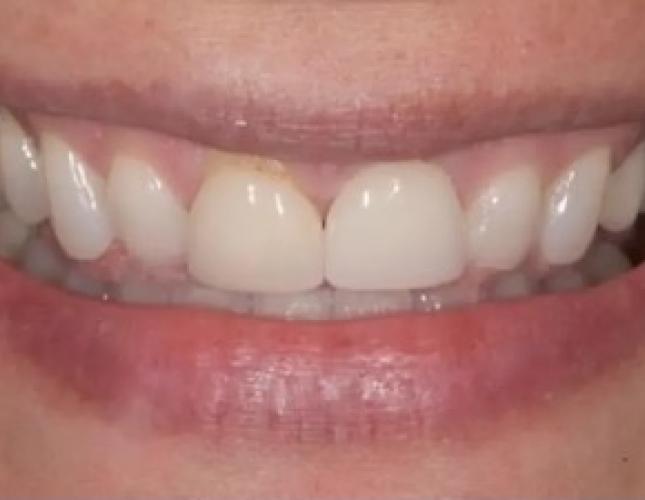 Case 1 before Case 1 before