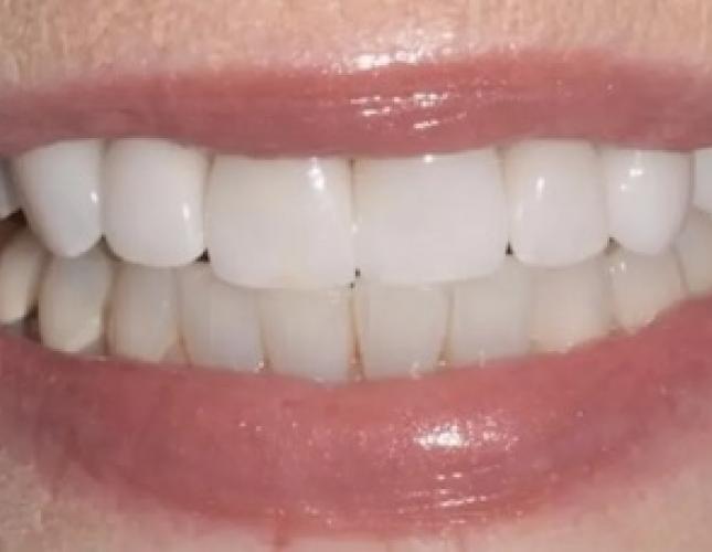 Case 2 after Case 2 after
