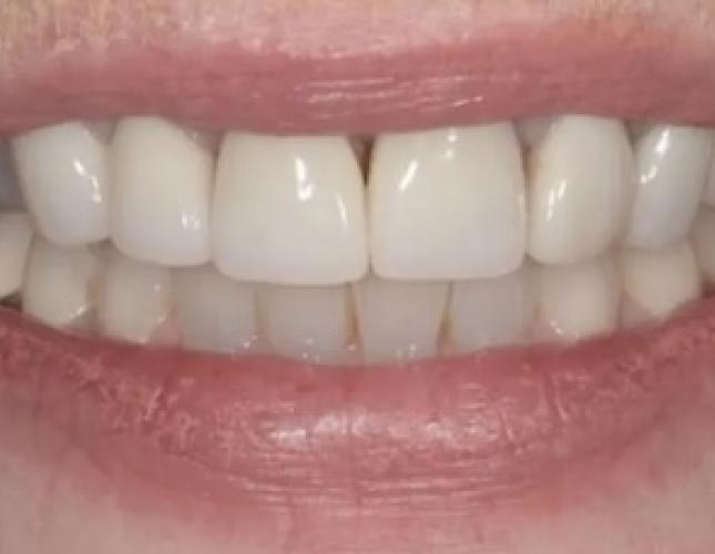 Case 2 before Case 2 before