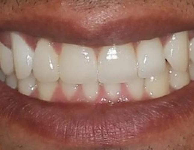 Case 4 after Case 4 after