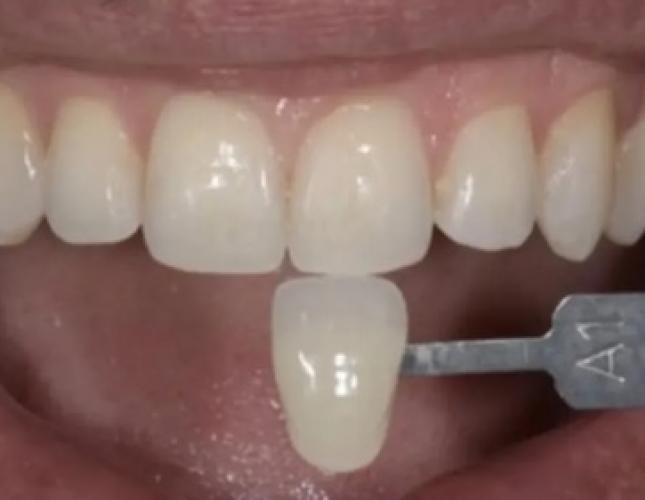Case 5 before