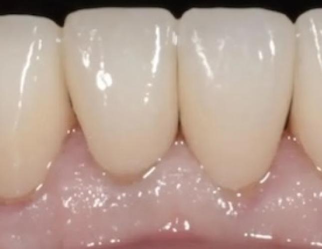 Case 6 after Case 6 after