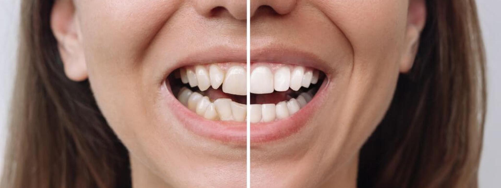 The Benefits of Cosmetic Dentistry: Procedures, Options, and Smile Enhancement